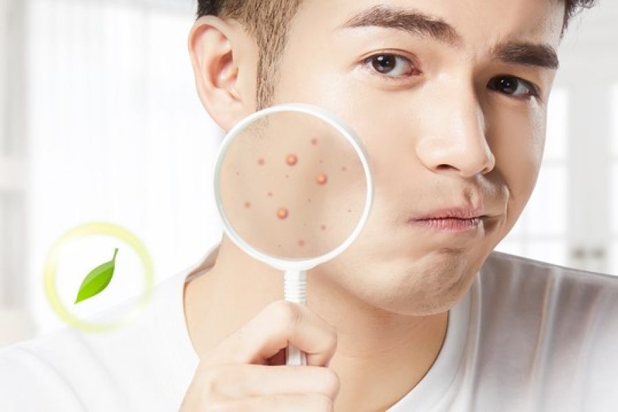 Acne Facial