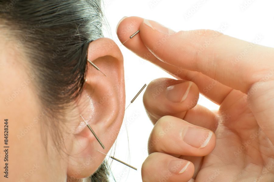 Auricular Therapy (Ear Acupuncture)